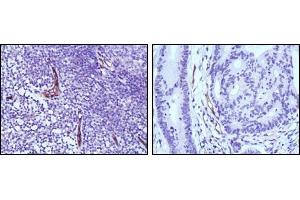 Immunohistochemical analysis of paraffin-embedded human lymph node (left) and colon cancer (right) tissues using eNOS antibody with DAB staining. (ENOS antibody)