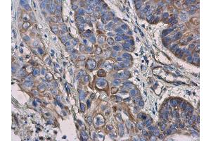 IHC-P Image IL3 Receptor alpha antibody [N2C2], Internal detects IL3 Receptor alpha protein at cell membrane and cytoplasm in human esophageal cancer by immunohistochemical analysis. (IL3RA antibody)