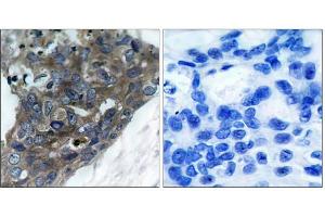 Immunohistochemical analysis of paraffin-embedded human breast carcinoma tissue, using ASK1 (Ab-966) antibody (E021134). (ASK1 antibody)