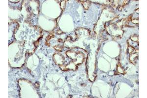 Formalin-fixed, paraffin-embedded human Angiosarcoma stained with CD31 Mouse Monoclonal Antibody (C31. (CD31 antibody)