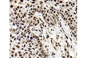 Immunohistochemistry of paraffin-embedded Human well-differentiated squamous skin carcinoma using HIRIP3 Polyclonal Antibody at dilution of 1:100 (40x lens). (HIRIP3 antibody)