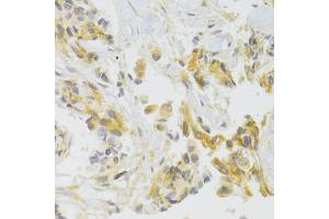 Immunohistochemistry of paraffin-embedded human breast cancer using EIF4G1 Antibody.