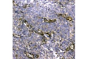 IHC testing of FFPE human lung cancer tissue with MYBPC3 antibody at 1ug/ml. (MYBPC3 antibody)