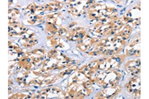 The image on the left is immunohistochemistry of paraffin-embedded Human thyroid cancer tissue using ABIN7189861(APOL6 Antibody) at dilution 1/50, on the right is treated with synthetic peptide. (APOL6 antibody)