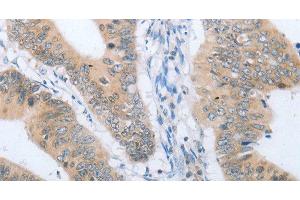 Immunohistochemistry of paraffin-embedded Human colon cancer tissue using CHRNA10 Polyclonal Antibody at dilution 1:50 (CHRNA10 antibody)