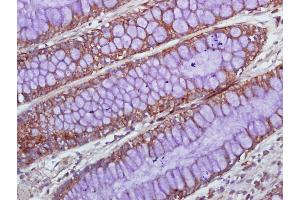 Paraformaldehyde-fixed, paraffin embedded Human colon cancer, Antigen retrieval by boiling in sodium citrate buffer (pH6. (IL1A antibody  (AA 151-220))