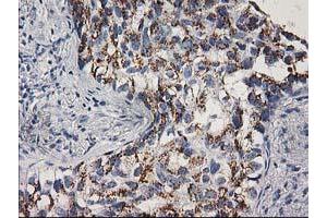 Immunohistochemical staining of paraffin-embedded Carcinoma of Human lung tissue using anti-CDK2 mouse monoclonal antibody.