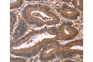 Immunohistochemistry of Human cervical cancer using CDC37L1 Polyclonal Antibody at dilution of 1:50 (CDC37L1 antibody)