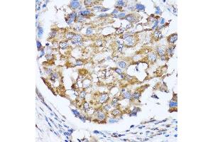 Immunohistochemistry of paraffin-embedded human breast cancer using NDE1 antibody. (NDE1 antibody  (AA 1-110))