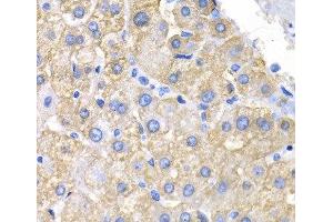 Immunohistochemistry of paraffin-embedded Human liver cancer using CRK Polyclonal Antibody at dilution of 1:200 (40x lens). (Crk antibody)