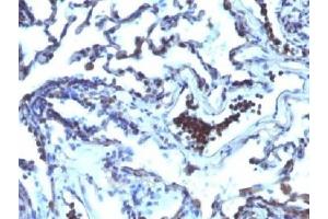 IHC testing of FFPE human lung carcinoma with TDP2 antibody (clone TDP2/1258). (TDP2 antibody)
