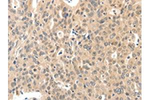 The image on the left is immunohistochemistry of paraffin-embedded Human ovarian cancer tissue using ABIN7192211(ROS1 Antibody) at dilution 1/40, on the right is treated with synthetic peptide. (ROS1 antibody)