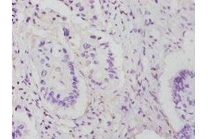 Immunohistochemistry of paraffin-embedded human colon cancer using ABIN7142748 at dilution of 1:25 (RPL14 antibody  (AA 2-214))