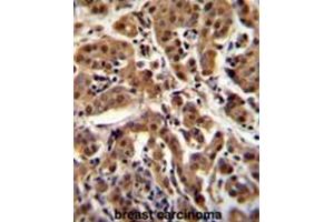 AKT1 Antibody (C-term T450) immunohistochemistry analysis in formalin fixed and paraffin embedded human breast carcinoma followed by peroxidase conjugation of the secondary antibody and DAB staining.