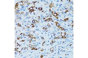 Immunohistochemistry of paraffin-embedded human uterine cancer using CTSE antibody. (Cathepsin E antibody)