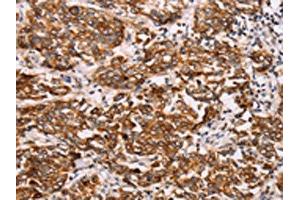 The image on the left is immunohistochemistry of paraffin-embedded Human breast cancer tissue using ABIN7192115(Rab3D Antibody) at dilution 1/27, on the right is treated with synthetic peptide. (RAB3D antibody)