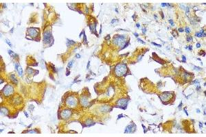 Immunohistochemistry of paraffin-embedded Human lung cancer using AARS Polyclonal Antibody at dilution of 1:100 (40x lens). (AARS antibody)