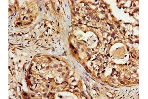 IHC image of ABIN7170140 diluted at 1:200 and staining in paraffin-embedded human cervical cancer performed on a Leica BondTM system. (SLC22A17 antibody  (AA 1-99))