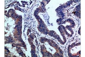 Immunohistochemical analysis of paraffin-embedded Human-colon-cancer, antibody was diluted at 1:100 (IL17F antibody  (AA 81-130))