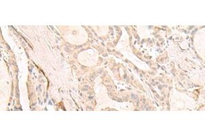 Immunohistochemistry of paraffin-embedded Human thyroid cancer tissue using DCD Polyclonal Antibody at dilution of 1:35(x200)