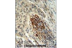 MF Antibody (C-term) 940b IHC analysis in formalin fixed and paraffin embedded human lung carcinoma followed by peroxidase conjugation of the secondary antibody and DAB staining. (MFAP4 antibody  (C-Term))