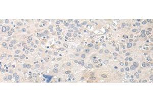 Immunohistochemistry of paraffin-embedded Human cervical cancer tissue using TUBG2 Polyclonal Antibody at dilution of 1:50(x200) (TUBG2 antibody)