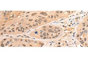 Immunohistochemistry of paraffin-embedded Human esophagus cancer tissue using BPGM Polyclonal Antibody at dilution of 1:70(x200)