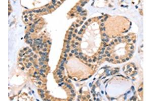 The image on the left is immunohistochemistry of paraffin-embedded Human thyroid cancer tissue using ABIN7130823(RASGEF1A Antibody) at dilution 1/20, on the right is treated with fusion protein. (RASGEF1A antibody)