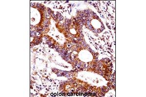 CEAC Antibody (Center) ((ABIN1537760 and ABIN2848792))immunohistochemistry analysis in formalin fixed and paraffin embedded human colon carcinoma followed by peroxidase conjugation of the secondary antibody and DAB staining. (CEACAM7 antibody  (AA 112-140))