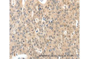 Immunohistochemistry of Human ovarian cancer using ROS1 Polyclonal Antibody at dilution of 1:40 (ROS1 antibody)