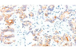 Immunohistochemistry of paraffin-embedded Human colon cancer tissue using CCDC88A Polyclonal Antibody at dilution 1:50 (Girdin antibody)
