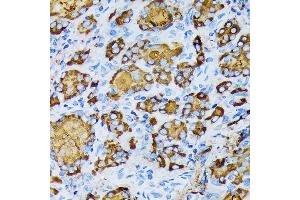 Immunohistochemistry of paraffin-embedded human thyroid cancer using γ-Tubulin Rabbit mAb (ABIN7271052) at dilution of 1:100 (40x lens). (TUBG1 antibody)