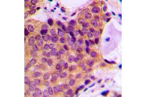 Immunohistochemical analysis of JNK1/2/3 (pT183) staining in human breast cancer formalin fixed paraffin embedded tissue section. (JNK antibody  (pSer183))
