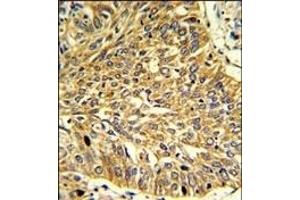 Formalin-fixed and paraffin-embedded human lung carcinoma reacted with RGP1 Antibody (C-term), which was peroxidase-conjugated to the secondary antibody, followed by DAB staining. (RGP1 antibody  (C-Term))