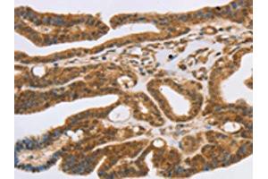 The image on the left is immunohistochemistry of paraffin-embedded Human thyroid cancer tissue using ABIN7192525(SLC7A9 Antibody) at dilution 1/35, on the right is treated with synthetic peptide. (SLC7A9 antibody)