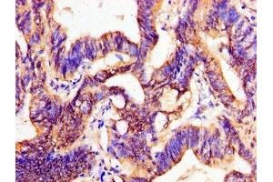 Immunohistochemistry of paraffin-embedded human colon cancer using ABIN7162750 at dilution of 1:100 (PTX3 antibody  (AA 99-164))