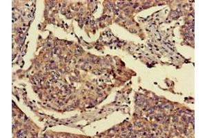 Immunohistochemistry of paraffin-embedded human cervical cancer using ABIN7153070 at dilution of 1:100 (FOXN1 antibody  (AA 1-160))