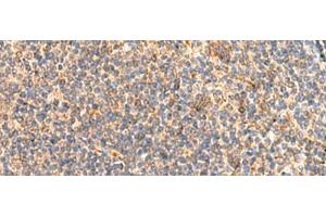Immunohistochemistry of paraffin-embedded Human tonsil tissue using ABHD2 Polyclonal Antibody at dilution of 1:40(x200) (ABHD2 antibody)