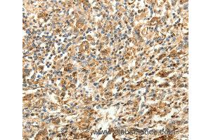 Immunohistochemistry of Human gastric cancer using SLC25A11 Polyclonal Antibody at dilution of 1:30 (SLC25A11 antibody)