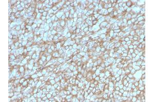 Formalin-fixed, paraffin-embedded human Melanoma stained with MCAM Mouse Monoclonal Antibody (MCAM/3048). (MCAM antibody  (AA 226-374))