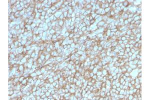 Formalin-fixed, paraffin-embedded human Melanoma stained with MCAM Mouse Monoclonal Antibody (MCAM/3048). (MCAM antibody  (AA 226-374))