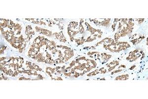 Immunohistochemistry of paraffin-embedded Human esophagus cancer tissue using ZNF248 Polyclonal Antibody at dilution of 1:25(x200) (ZNF248 antibody)