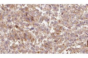 ABIN6279251 at 1/100 staining Human Melanoma tissue by IHC-P. (CPA6 antibody  (Internal Region))