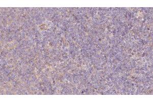 ABIN6273066 at 1/100 staining Human lymph cancer tissue by IHC-P. (PPPDE1 antibody  (Internal Region))