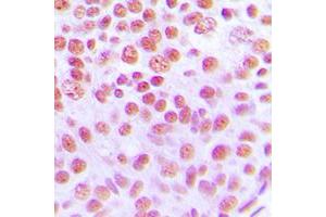 Immunohistochemical analysis of Cytokine IK staining in human breast cancer formalin fixed paraffin embedded tissue section. (Protein Red (IK) (C-Term) antibody)