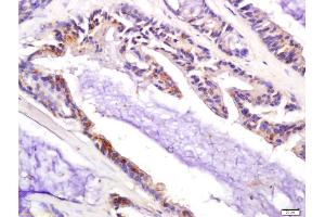 Formalin-fixed and paraffin embedded human colon carcinoma labeled with Anti-P21 Polyclonal Antibody, Unconjugated (ABIN1714474) at 1:200 followed by conjugation to the secondary antibody and DAB staining (p21 antibody  (AA 21-100))