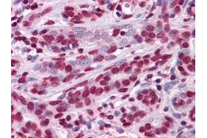 Immunohistochemical analysis of paraffin-embedded human Breast tissues using anti-ZBTB7B mouse mAb (ZBTB7B antibody)