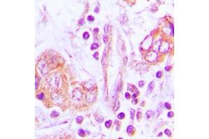 Immunohistochemical analysis of OTUB2 staining in human lung cancer formalin fixed paraffin embedded tissue section. (OTUB2 antibody  (Center))