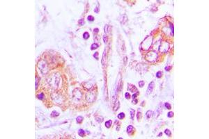 Immunohistochemical analysis of OTUB2 staining in human lung cancer formalin fixed paraffin embedded tissue section.