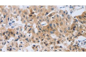 Immunohistochemistry of paraffin-embedded Human lung cancer tissue using NEB Polyclonal Antibody at dilution 1:80